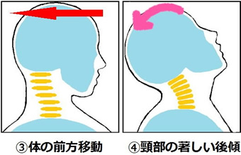 むち打ち発生のメカニズム2
