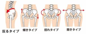 日常の何気ない習慣が骨盤を歪ませる？原因と対策を徹底解説！